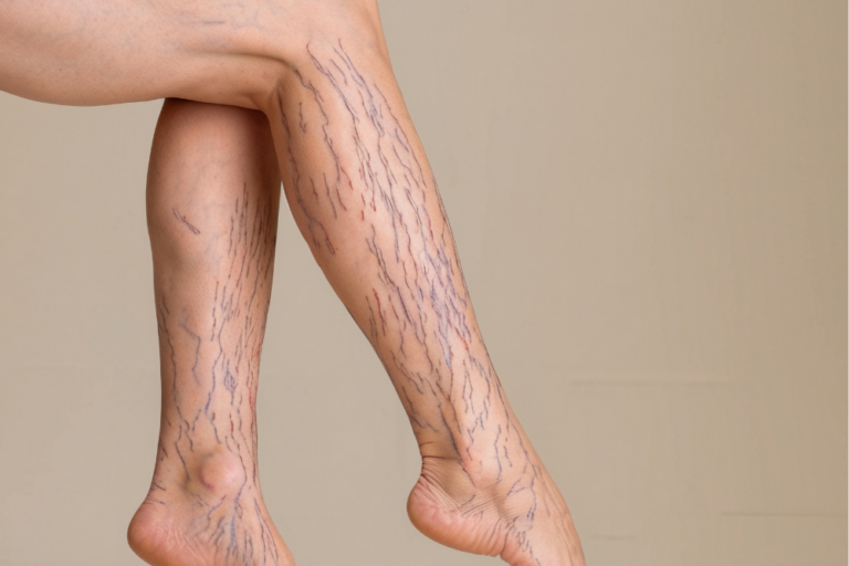 9 Home Remedies to Treat and Prevent Varicose Veins